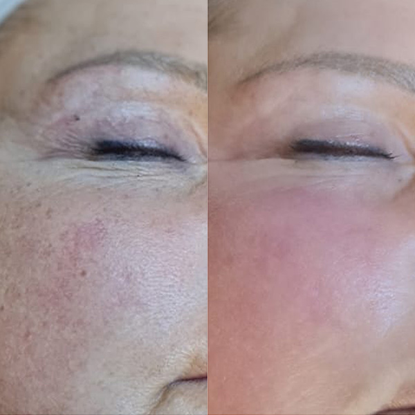 Before and after algae peel - pigmentation and skin tone improvement