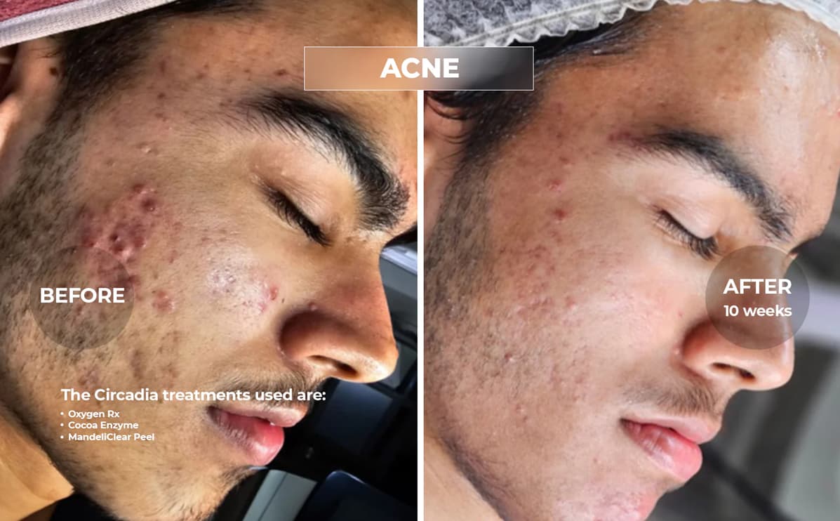 Chemical peel before and after result 2