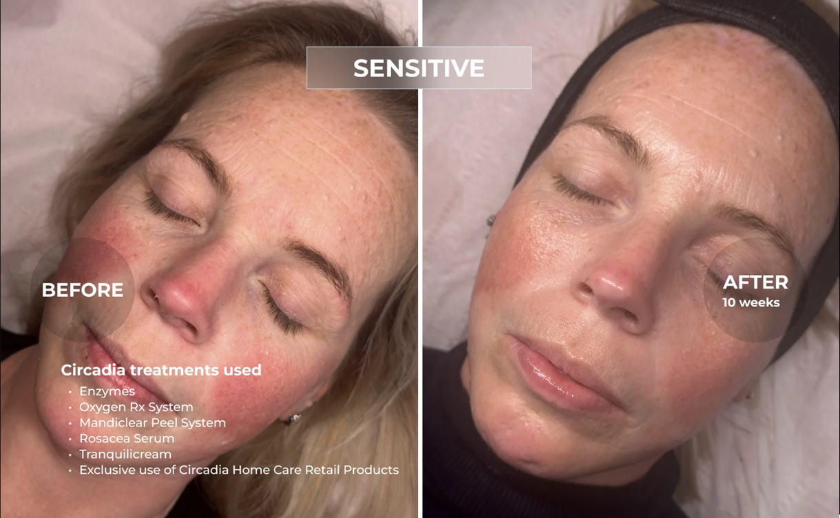 Chemical peel before and after result 1