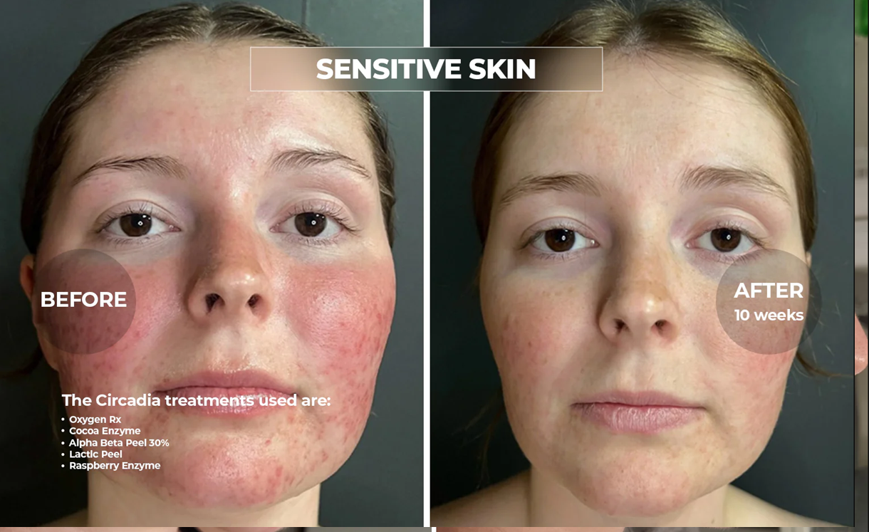 Chemical peel before and after result 3