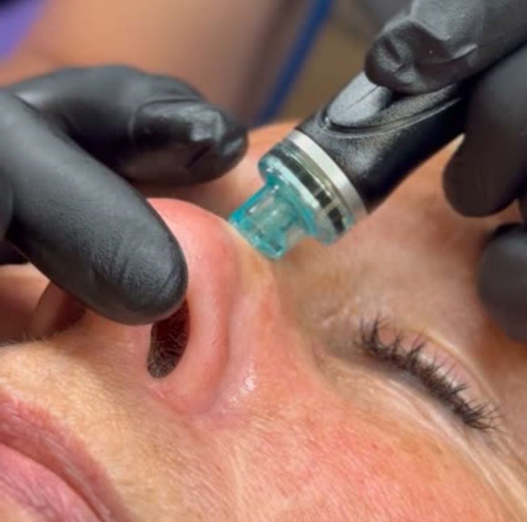 HydraFacial treatment