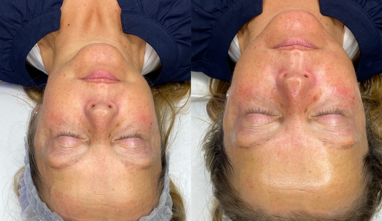 HydraFacial before and after result 1