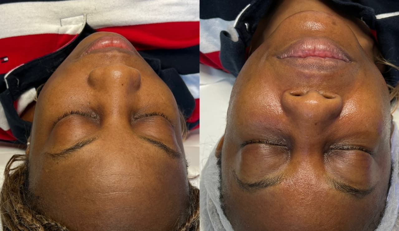 HydraFacial before and after result 2