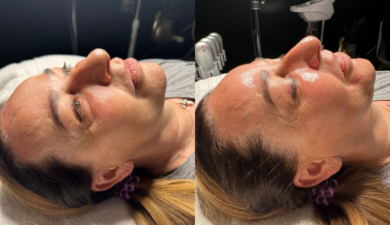 HydraFacial before and after result 3