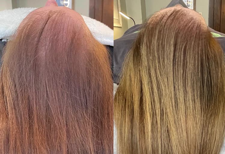 HydraScalp® with Keravive® before and after — result 1
