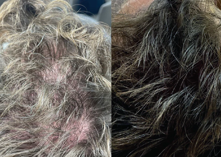 HydraScalp® with Keravive® before and after — result 2