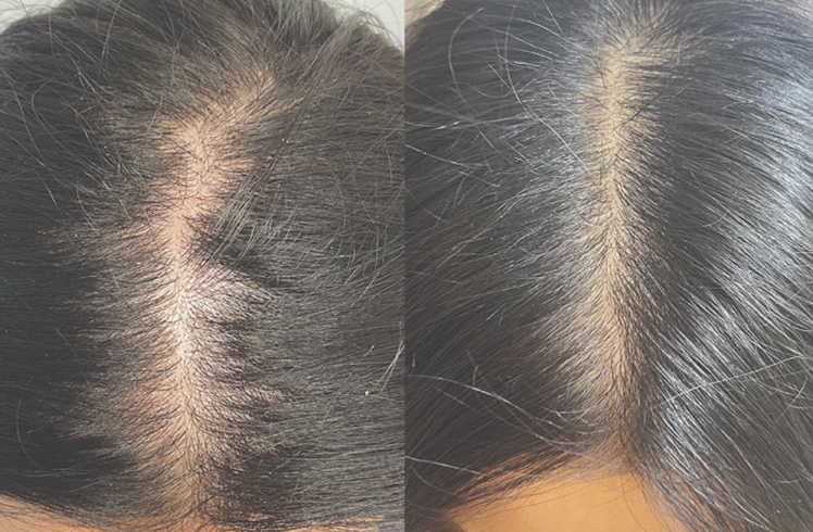 HydraScalp® with Keravive® before and after — result 3
