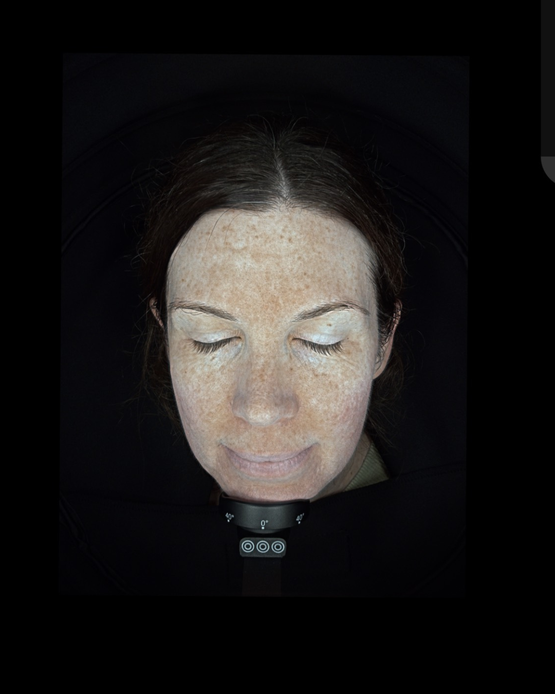 Hidden Pigmentation