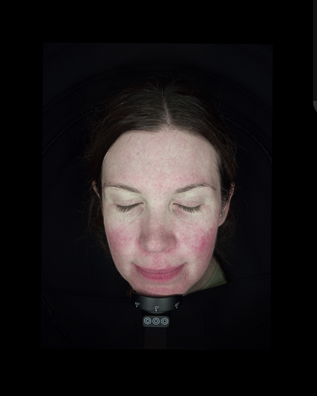 Redness & Vascularity