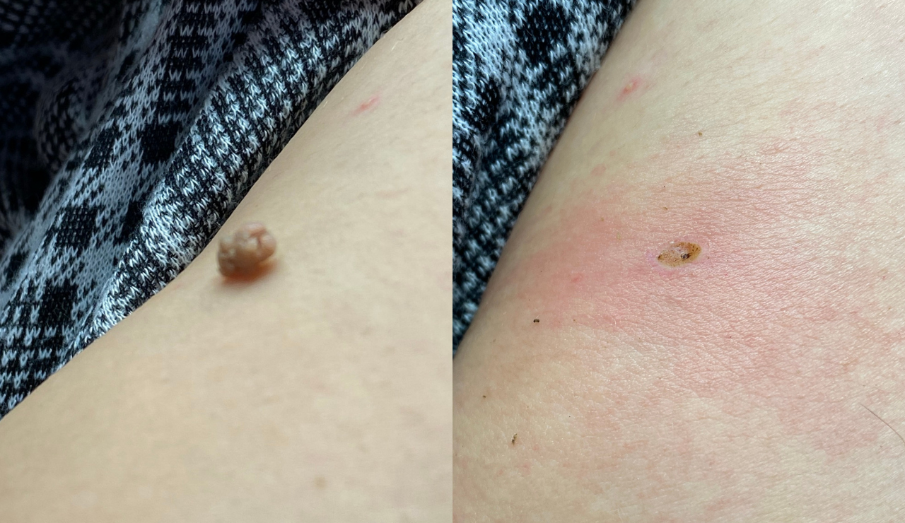 Skin tag removal result - neck area