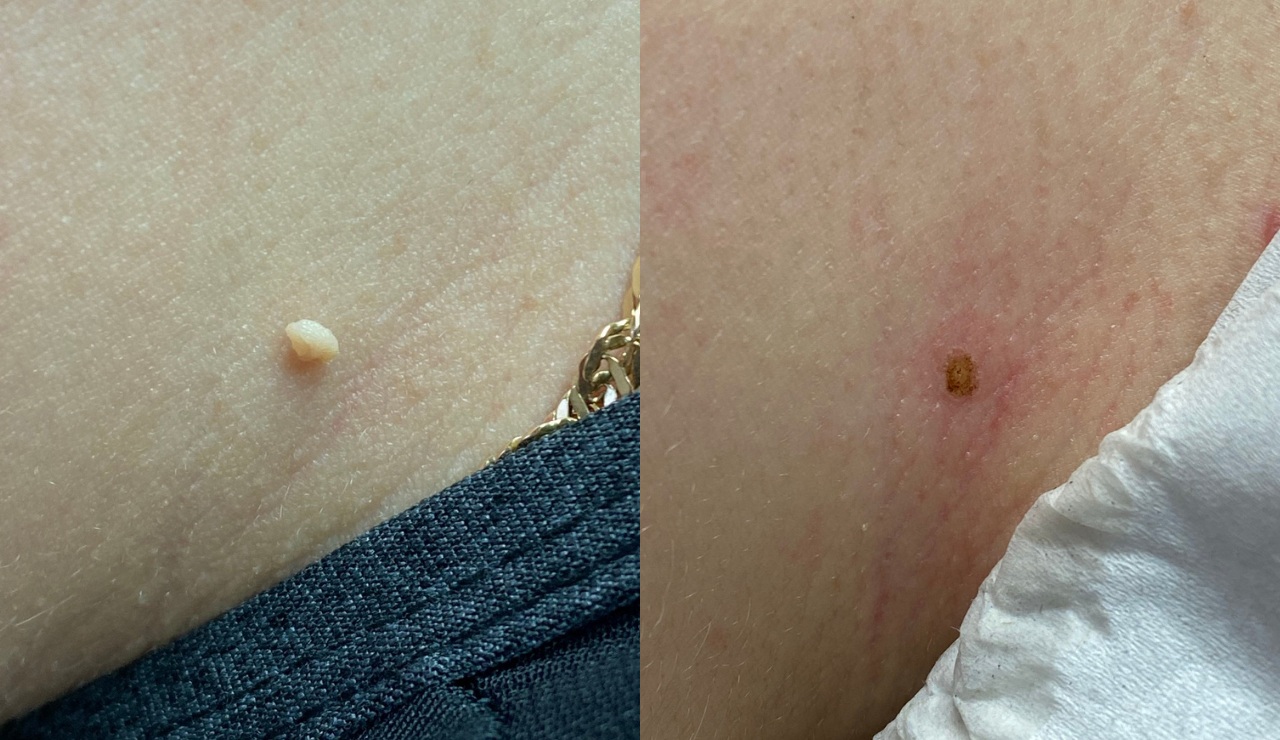 Skin tag removal healing result