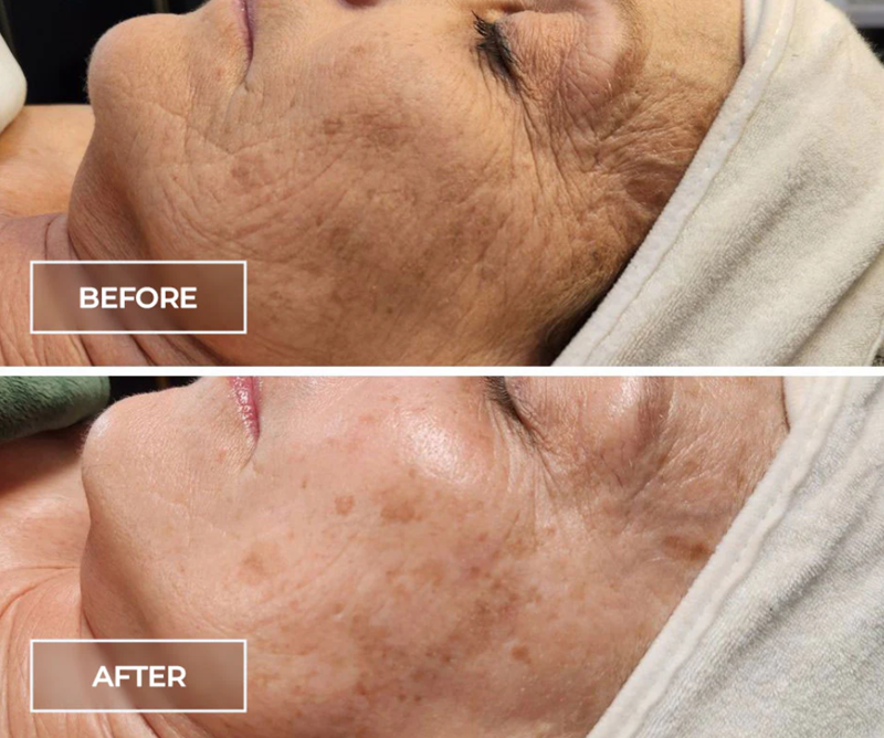 Circadia SWiCH™ before and after — result 1