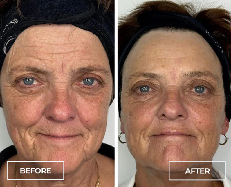 Circadia SWiCH™ before and after — result 2