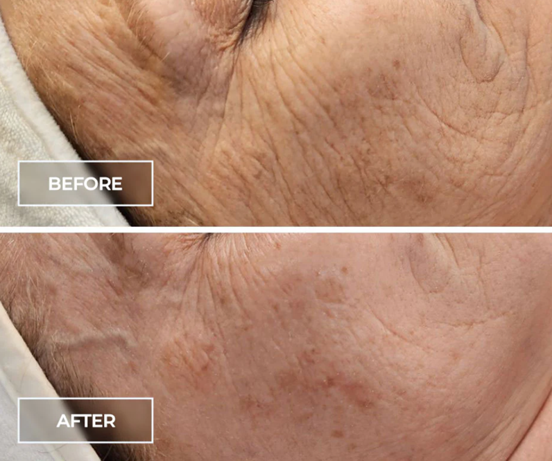 Circadia SWiCH™ before and after — result 3